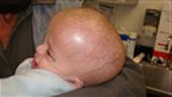 cisti nella testa del neonato