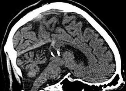 arahnoidna cista zdravljenje možganov