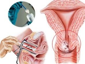 citologijo materničnega vratu