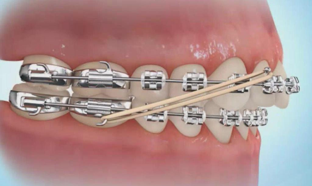 ortodontickou elastickou trakcí