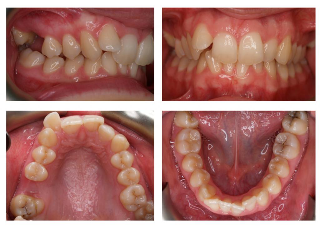 leczenie aparatem ortodontycznym zdjęcie