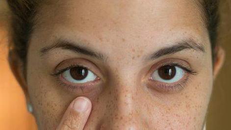 Tmavé oční víčka zasahují, co dělat?