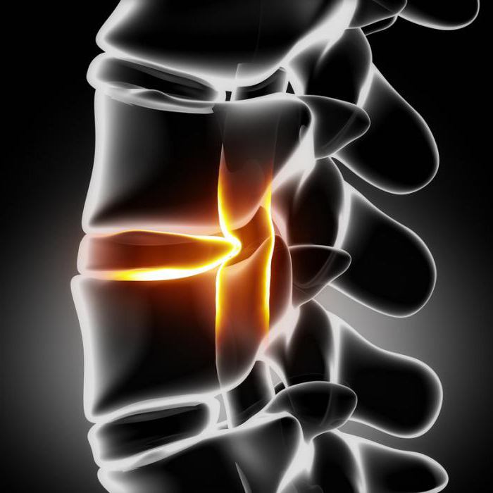 дегенеративни дистрофични промени на гръбначния стълб