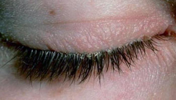 zdravljenje demodex očesa doma