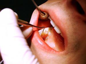 Strumień zębów szybko usunięty