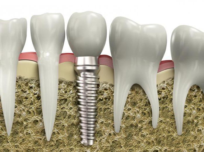 implantacija kontraindikacij zob in možnih zapletov