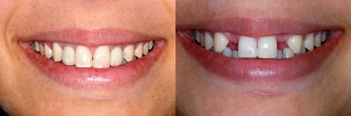 implantacija kontraindikacij zob