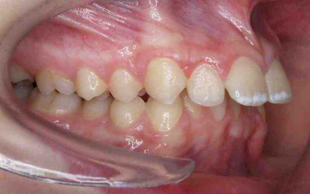 kaj so kontraindikacije za zobne vsadke