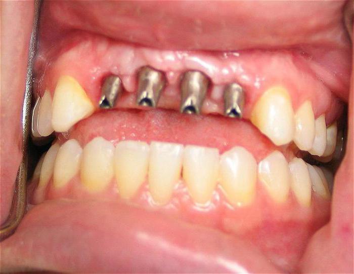 zapleti po zobni implantaciji