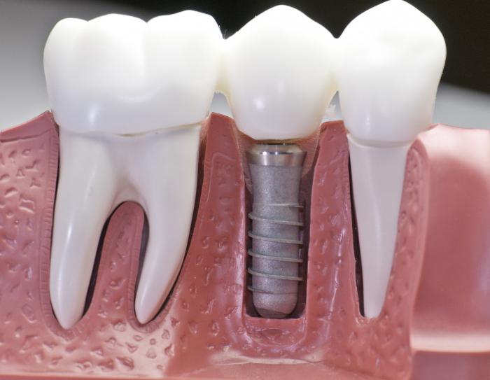 Фазе имплантације зуба