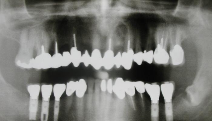 Колико кошта једна имплантација зуба?