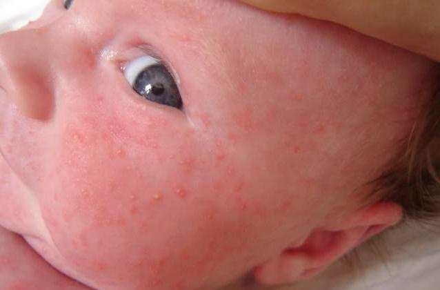 Dermatite atipica nei bambini