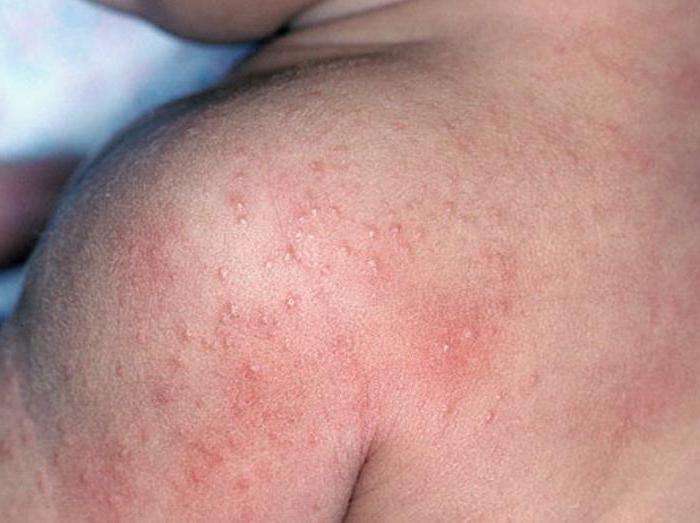 Dermatitis Atypické příznaky