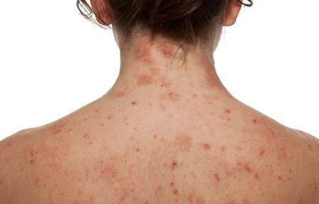 Dermatite atipica negli adulti