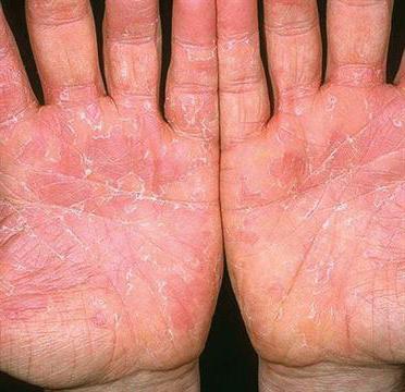 fotografija eksfoliativnega dermatitisa