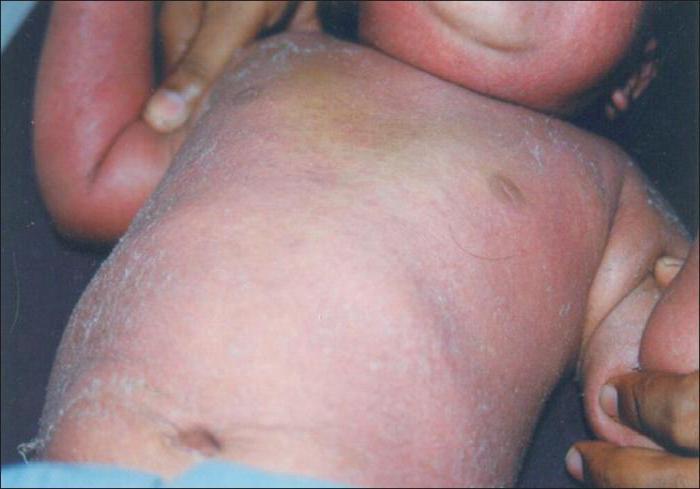 eksfoliativni dermatitis pri odraslih