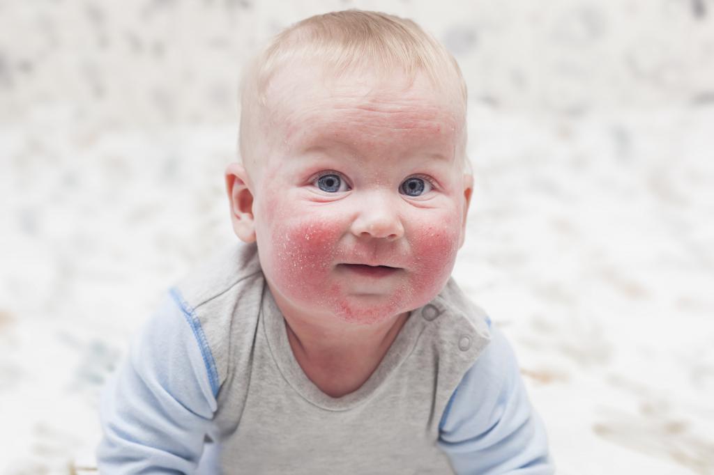 Dermatite atopica in un bambino