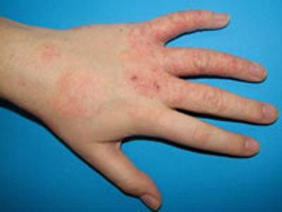 Dermatite sulle mani