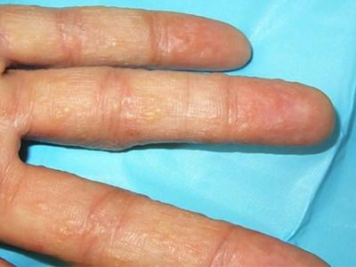 Dermatite nelle mani dei bambini