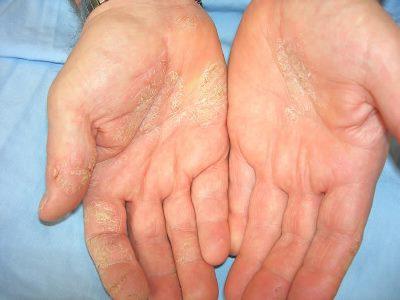 Како се лечи дерматитис на рукама