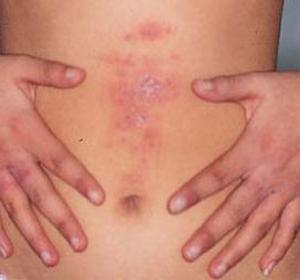trattamento della dermatite con rimedi popolari