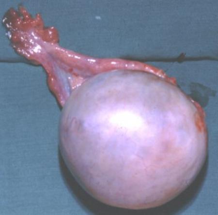 снимка на дермоидни яйчници