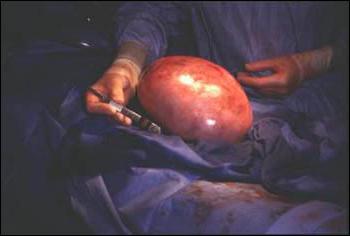 операција дермоидне цисте јајника