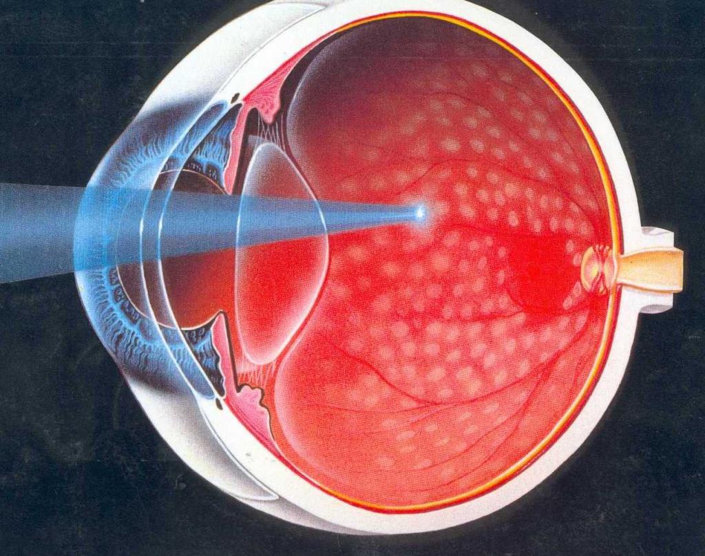 Coagulazione laser della retina
