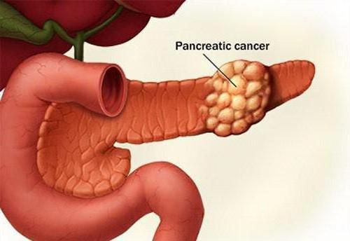 diagnostiku pankreatitidy u dospělých
