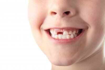 termini di perdita di denti da latte nei bambini