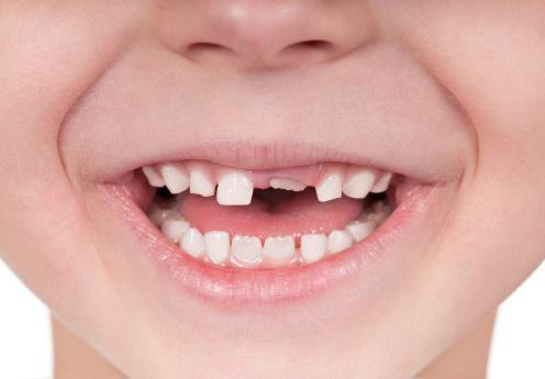 denti da latte nei bambini
