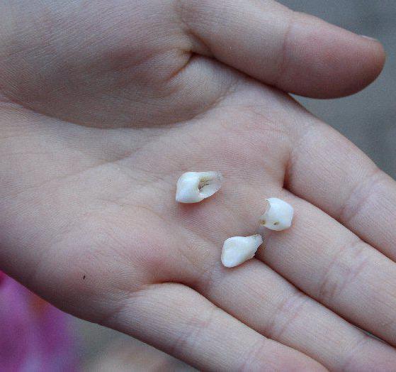 perdita di denti primari nell'età infantile
