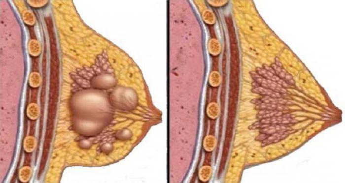 diffuso fibroadenomatosis del trattamento delle ghiandole mammarie