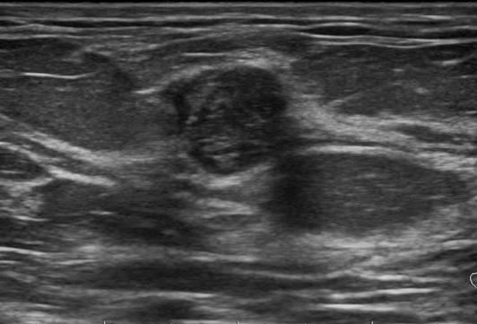 segni di fibroadenomatosi diffusa delle ghiandole mammarie
