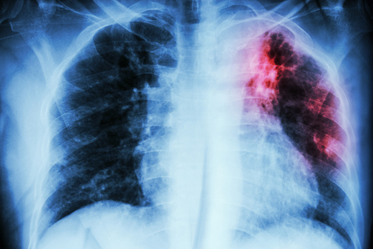 Segni di fibrosi polmonare polmonare diffusa