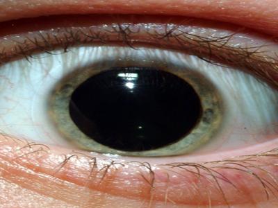 Segno di pupille dilatate