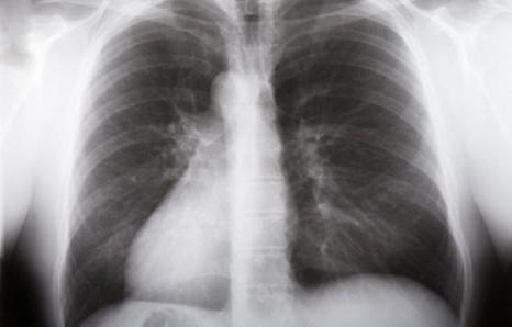 ematoma delle cause polmonari