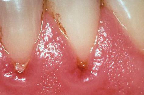 zob in bolezni dlesni