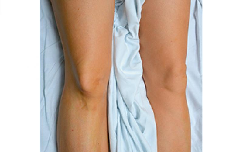 Symptomy vykloubení kolena