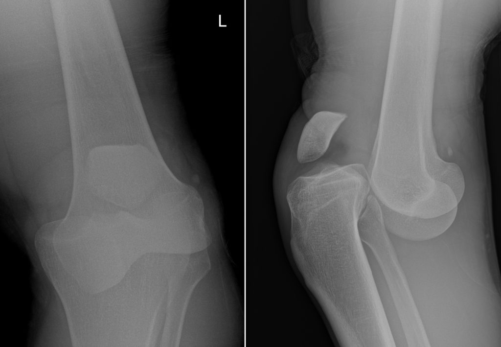 Klinický obraz vykloubení kolena