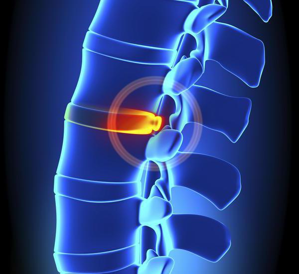 hrbtne izbokline ledvenih diskov