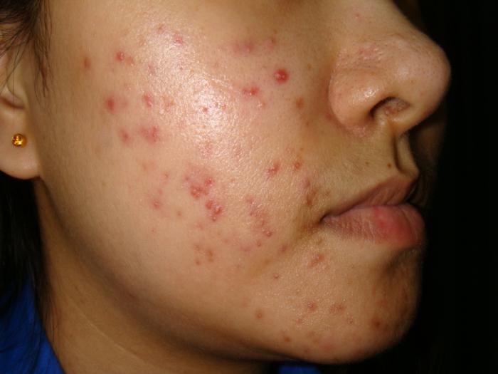 trattamento dell'acne doxiciclina