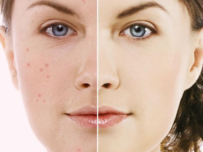 doxycycline acne pregledi