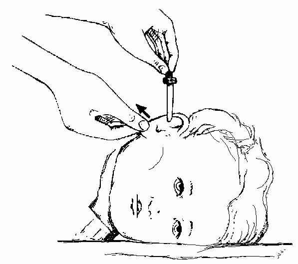 L'orecchio cade durante l'otite, l'applicazione