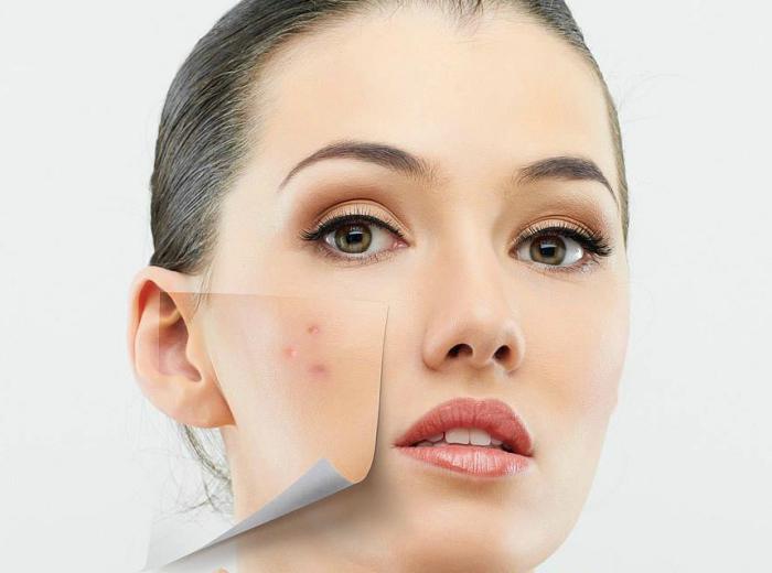 recensioni di acne zincteral