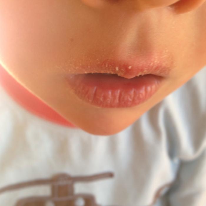 otroške ustnice suhe