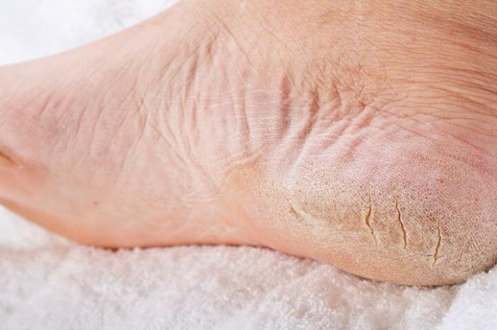 suchá šupinatá kůže na nohou