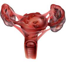 Duphaston per il concepimento con endometriosi
