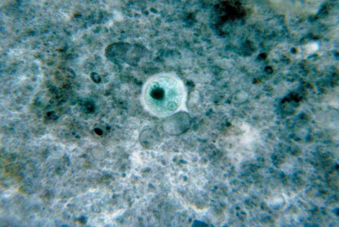 Ameba dissenterico