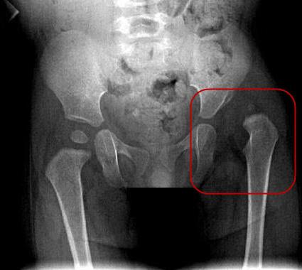 displasia dell'anca nella diagnosi infantile